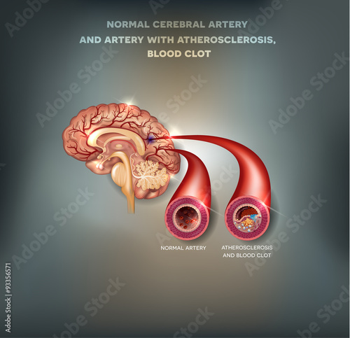 Healthy and unhealthy brain arteries