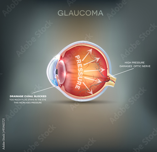 Glaucoma photo
