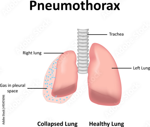 Pneumothorax Illustration