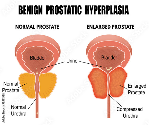 Benign prostatic hyperplasia