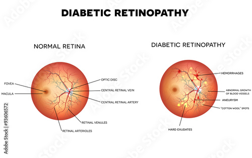 Fototapeta Naklejka Na Ścianę i Meble -  Diabetic retinopathy