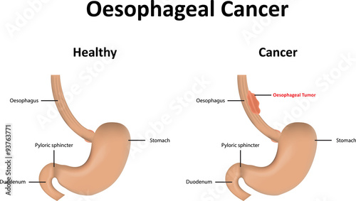 Billede på lærred Oesophageal Cancer Illustration