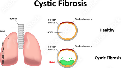 Cystic Fibrosis in the Lungs photo