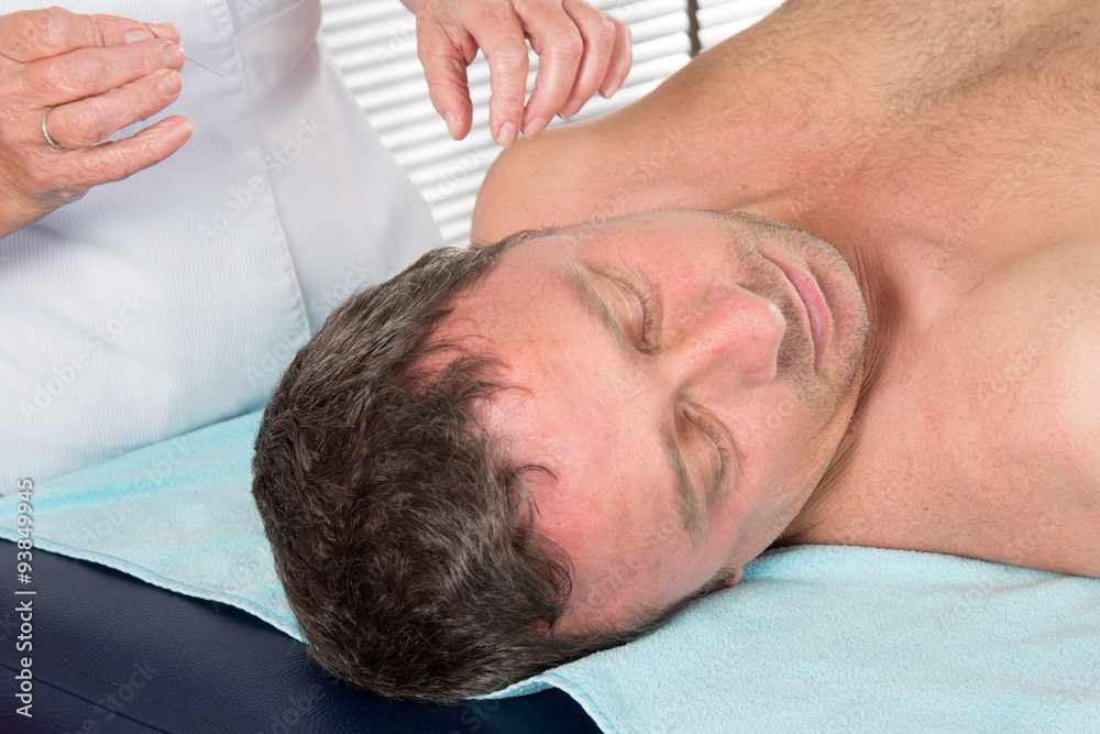 Adult physiotherapist is doing acupuncture on the back of a male patient. Adult physiotherapist is doing acupuncture on the back of a male patient.