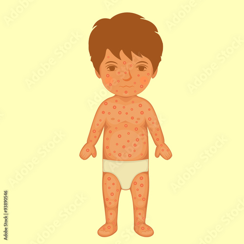 sick child, skin rash, chicken pox disease