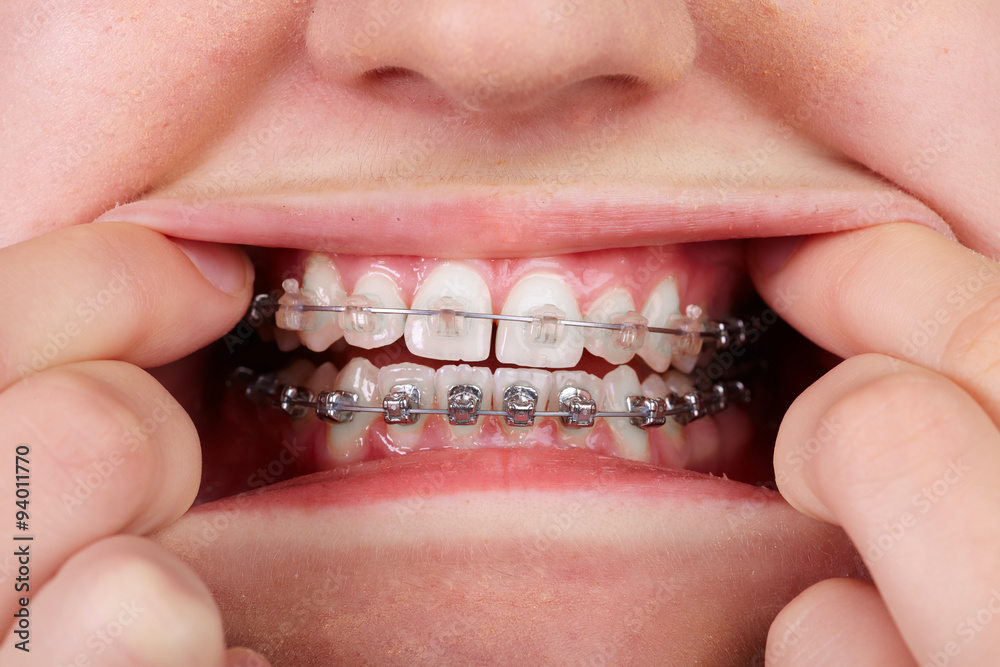 Naklejka premium Teeth with orthodontic brackets.