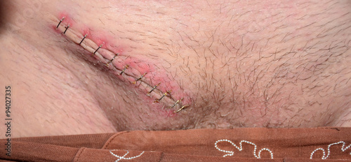 Castration Scar photo