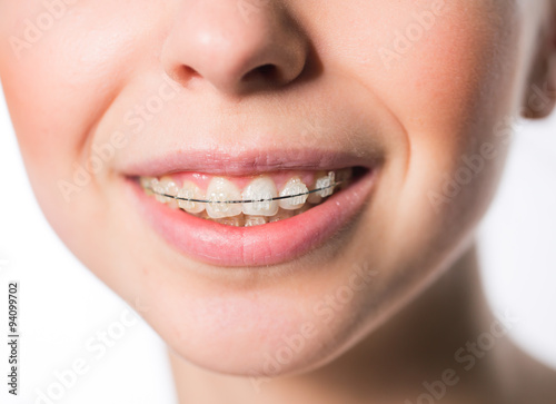 Woman mouth with teeth braces