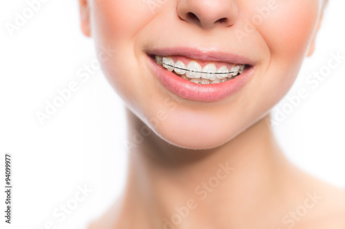Woman mouth with teeth braces photo