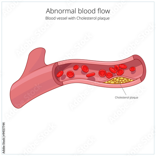 Blood vessel and cholesterol plaque vector photo