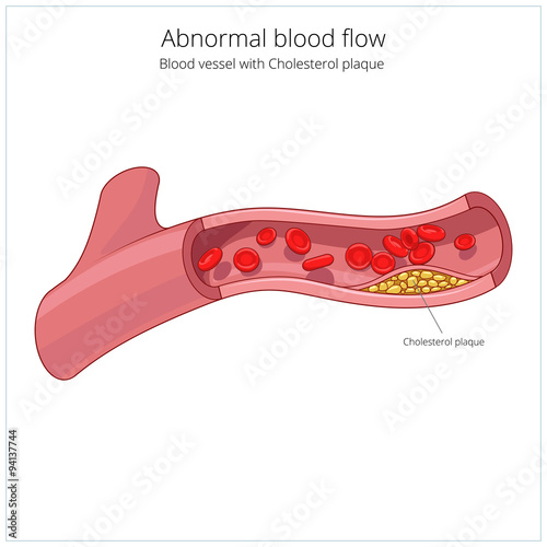 Blood vessel and cholesterol plaque vector