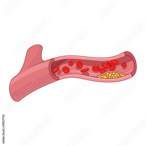 Blood vessel and cholesterol plaque vector photo