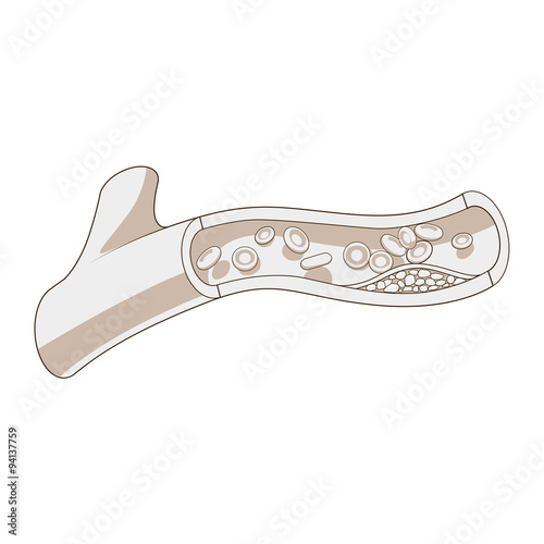 Blood vessel and cholesterol plaque vector