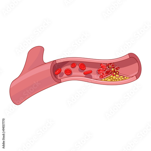 Blood vessel and clot thrombus vector illustration