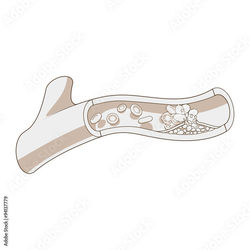 Blood vessel and clot thrombus vector illustration