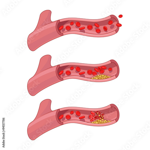 Blood vessel and clot thrombus vector illustration photo