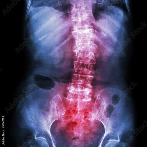 Photography Spondylosis and Scoliosis ( film x-ray lumbar - sacrum spine show crooked spine