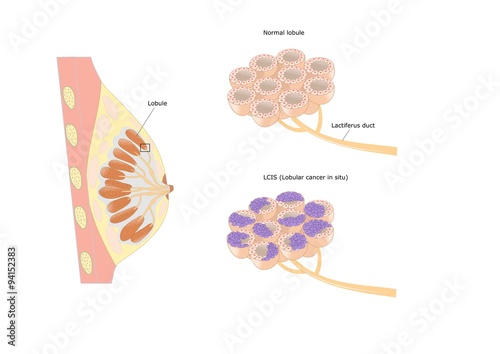 tipologia di cancro al seno: cancro lobulare