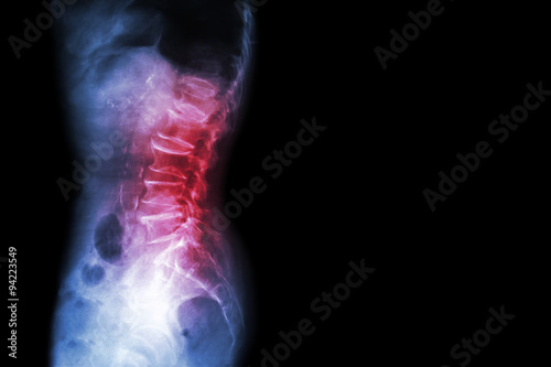 Cuadro en lienzo Spondylosis , Spondylolisthesis  ( Film x-ray lumbo - sacral spine show spine co