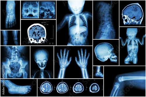X-ray multiple part of child 's body & multiple disease ( stroke , brain tumor , rheumatoid arthritis , sinusitis , gouty arthritis , etc)( skull chest lung heart spine arm hand pelvis leg knee foot )
