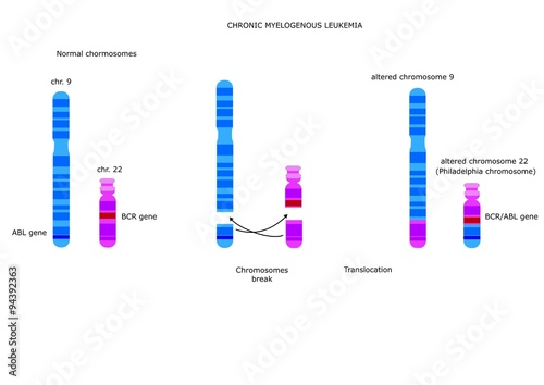 difetto cromosomico portatore della leucemia mieloide cronica (cromosoma Philadelphia)