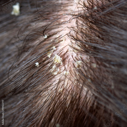 Dandruff in the hair. Flaky scalp.