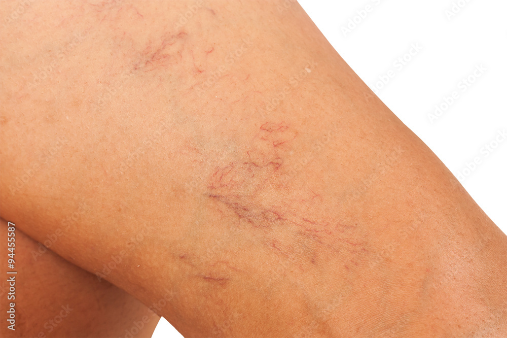 Varicose veins on the legs of middle-aged women. Varicose veins on the legs of middle-aged women.
