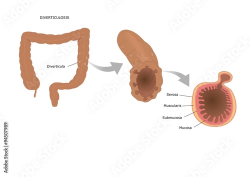 patologia intestinale: diverticolosi del colon