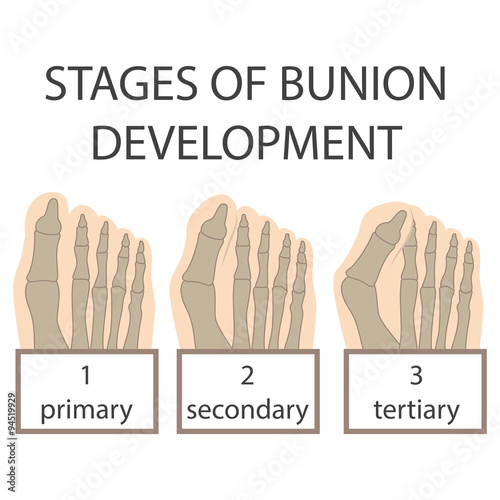 human foot. vector illustration of bunion development