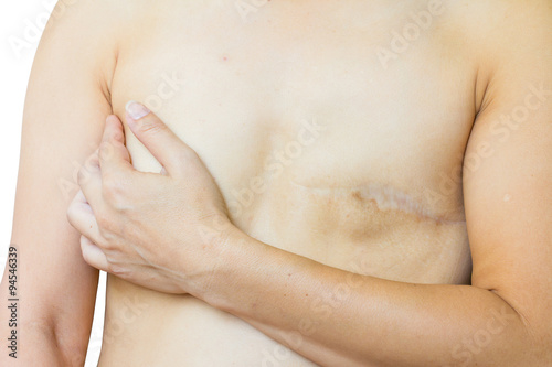 closeup asian woman with big scar after breast surgery, breast cancer, isolated on white
