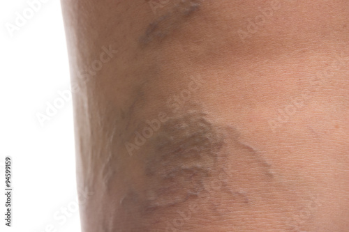 Varicose vein women Isolated on white background