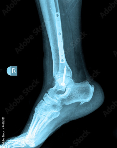 xray of foot by side view with screw  