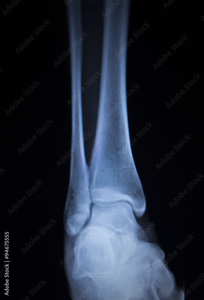 X-ray orthopedics scan of painful ankle foot injury X-ray orthopedics scan of painful ankle foot injury