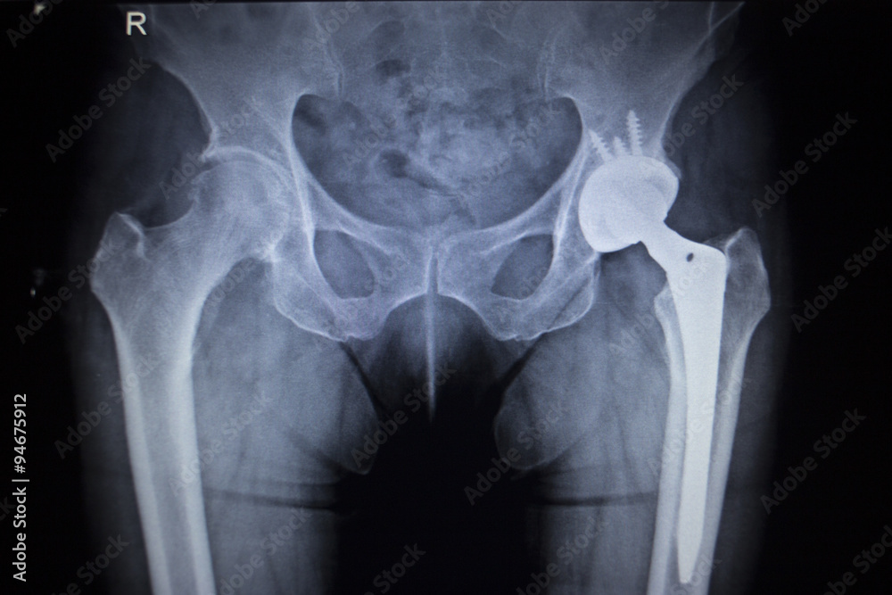 X-ray scan image of hip joint replacement orthopedic implant Stock ...