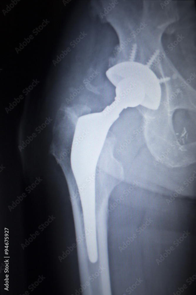X-ray scan image of hip joint replacement orthopedic implant Stock ...