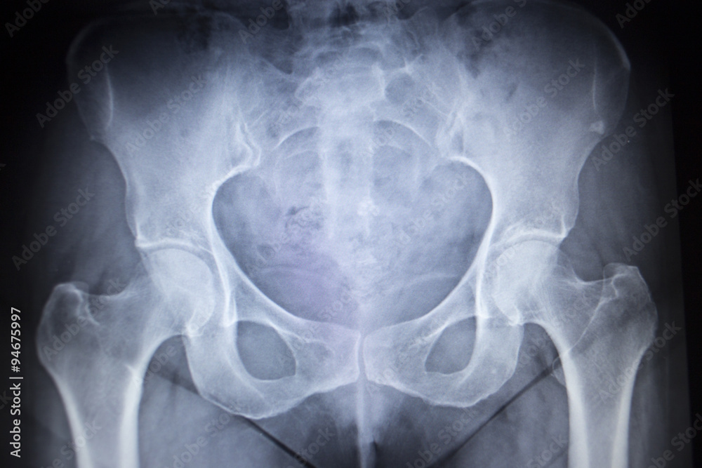 X-ray orthopedic scan image of hip joints human skeleton Stock Photo ...
