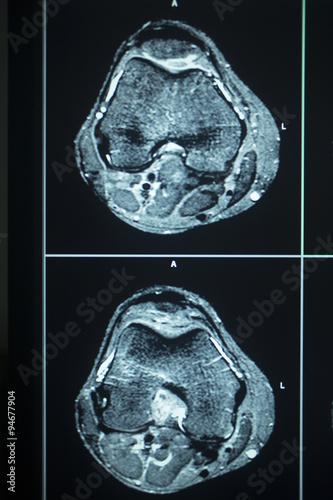 Canvas Print MRI scan test results knee meniscus injury