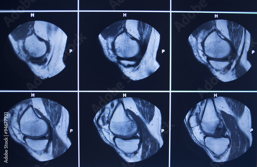 MRI scan test results knee meniscus injury photo