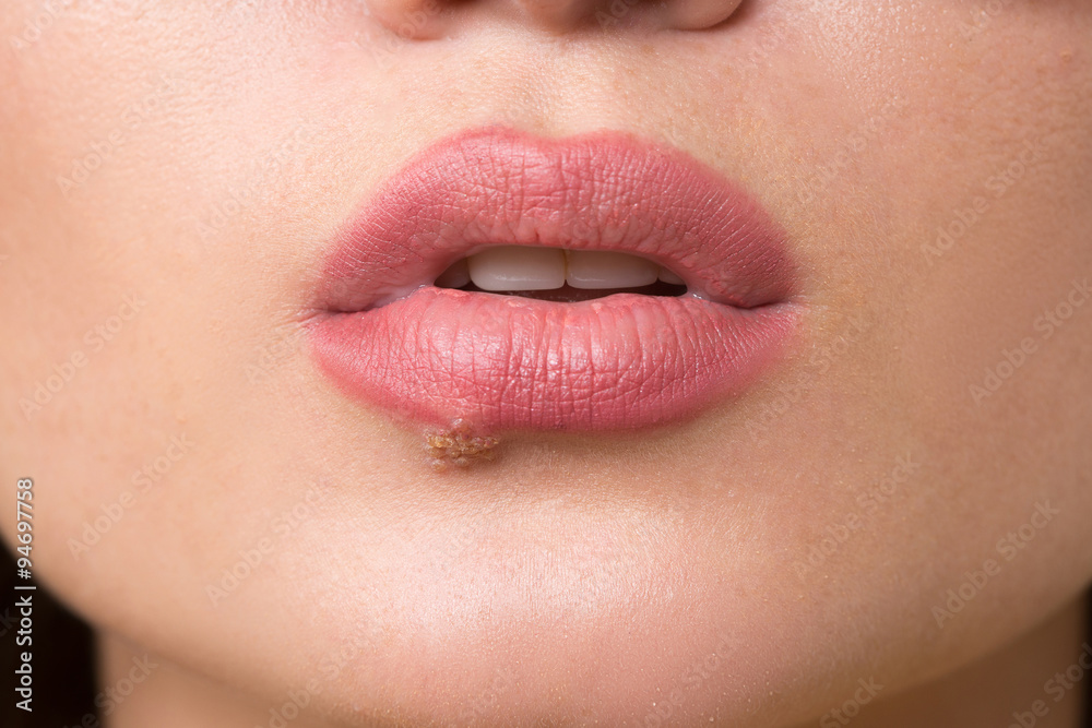 beautiful lips virus infected herpes Stock Photo Adobe Stock