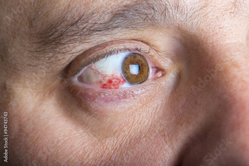 Derrame ocular o hiposfagma en un hombre adulto, enfermedades y cuidado de la vista