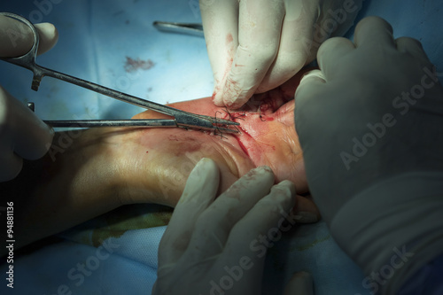 Sewing up the hand