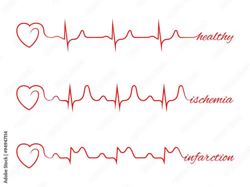 Heart beats various cardiogram vector set