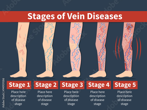 Varicose infographic