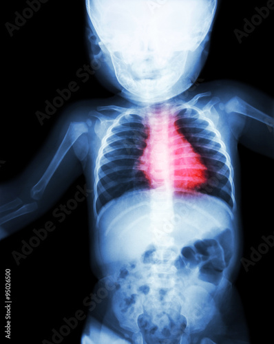 Film x-ray whole child 's body with heart disease ( Rheumatic heart disease , Valvular heart disease ) ( Cardiovascular system )