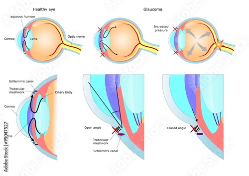 Fototapeta Naklejka Na Ścianę i Meble -  malattia oculare: glaucoma