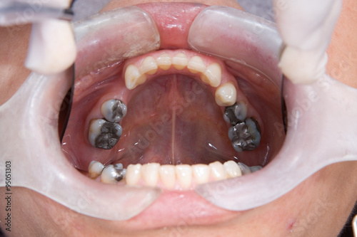 Foto protesis parcial removible