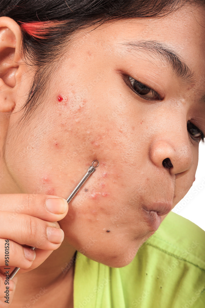 Fototapeta premium acne on skin face women