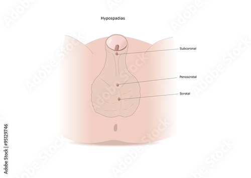 malformazione congenita neonatale: ipospadia