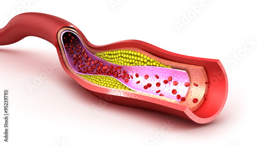 Cholesterol plaque in blood vessel, illustration photo