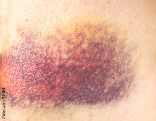 great bruise photo
